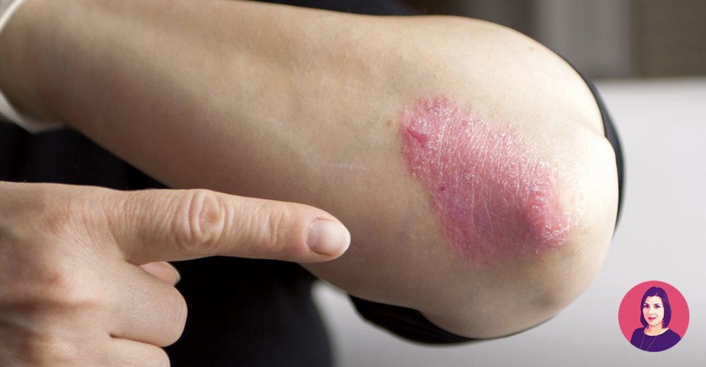 psoriasi