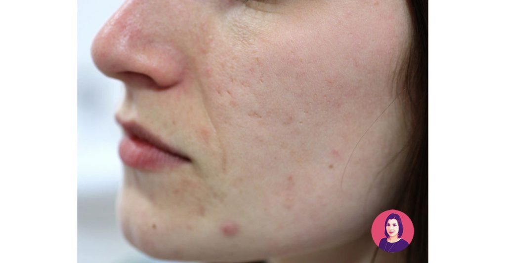 eliminare segni dell’acne