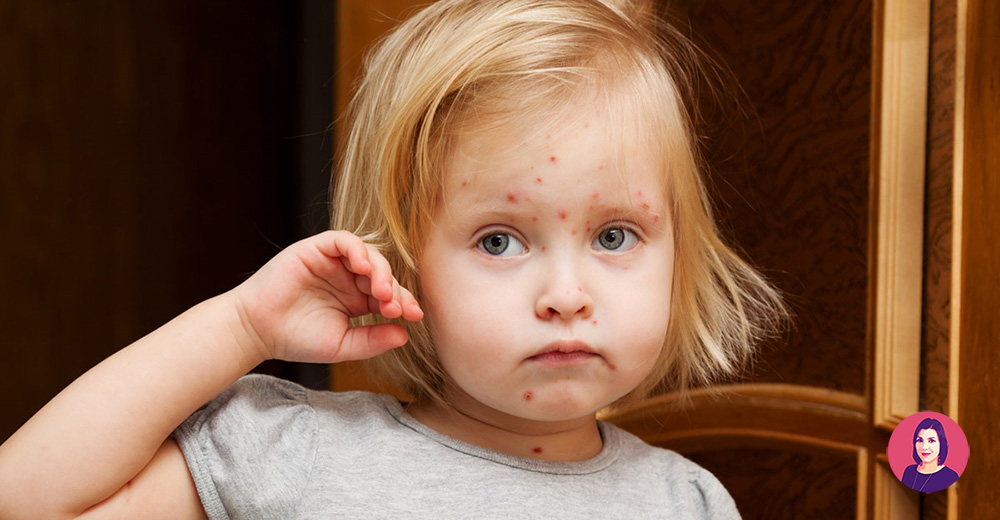 cicatrici varicella bambini
