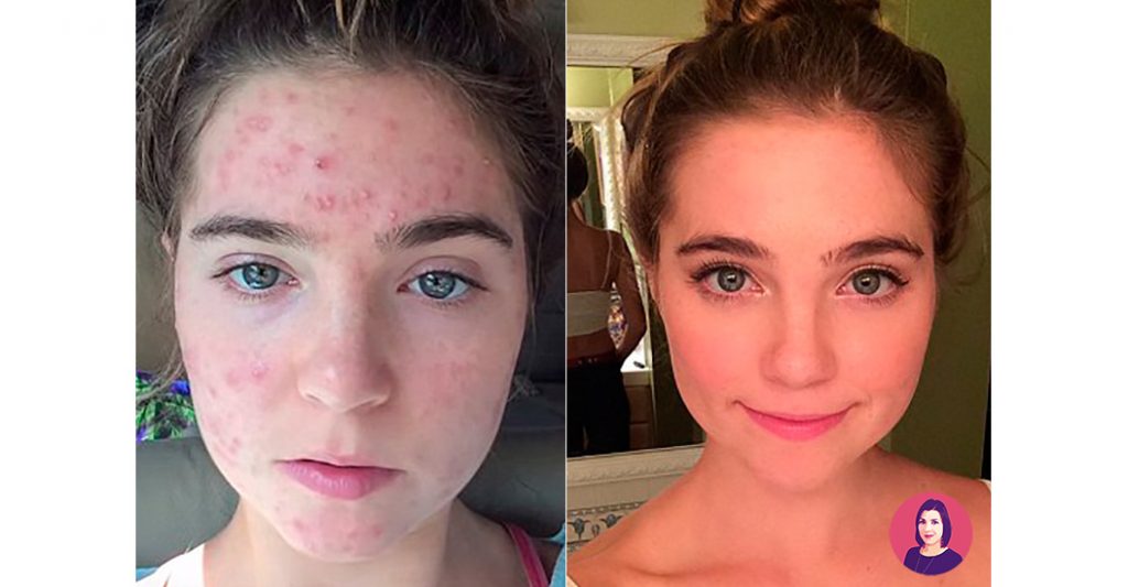 acne grave giovanile